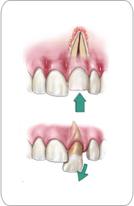 Dislodged teeth