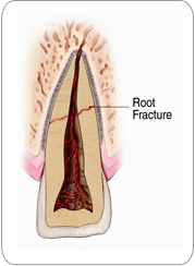 Root Fractures